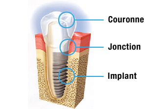 les avantages des implants dentaires